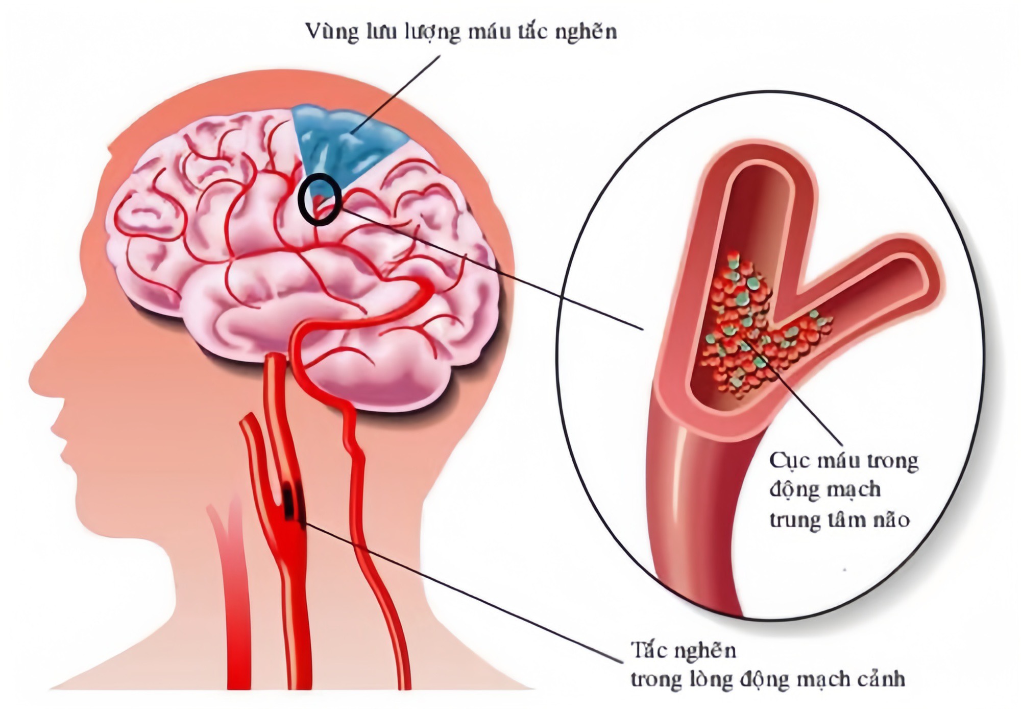 Hình 4 - Nguyên nhân gây đột quỵ là do thiếu tuần hoàn máu não